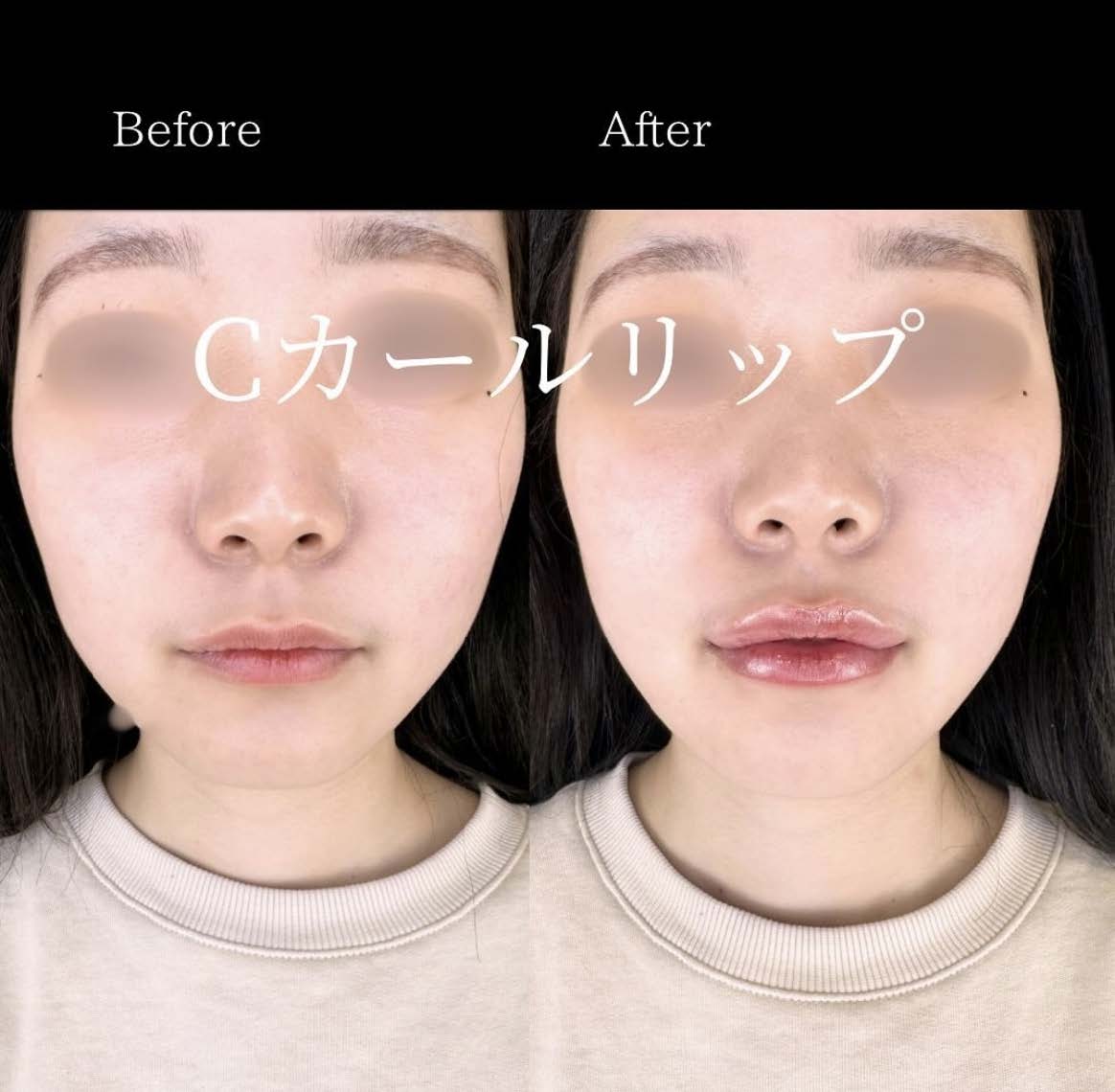 Cカールリップの症例写真