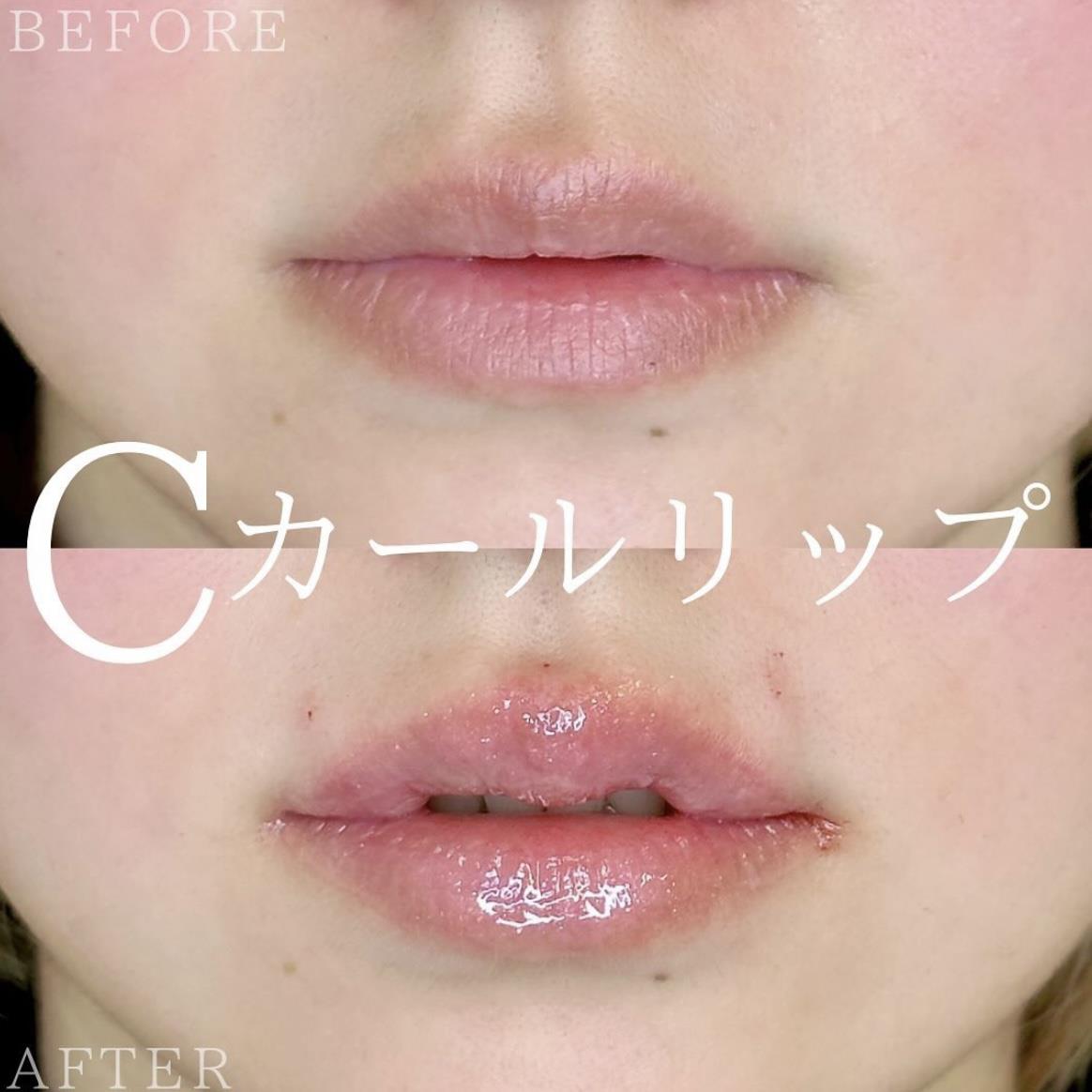 Cカールリップの症例写真