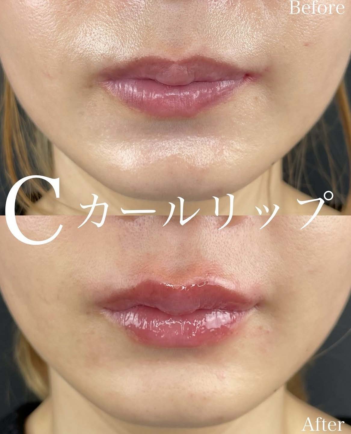 Cカールリップの症例写真