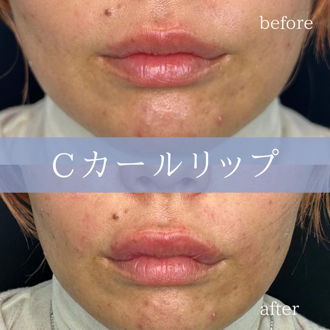 Cカールリップの症例写真
