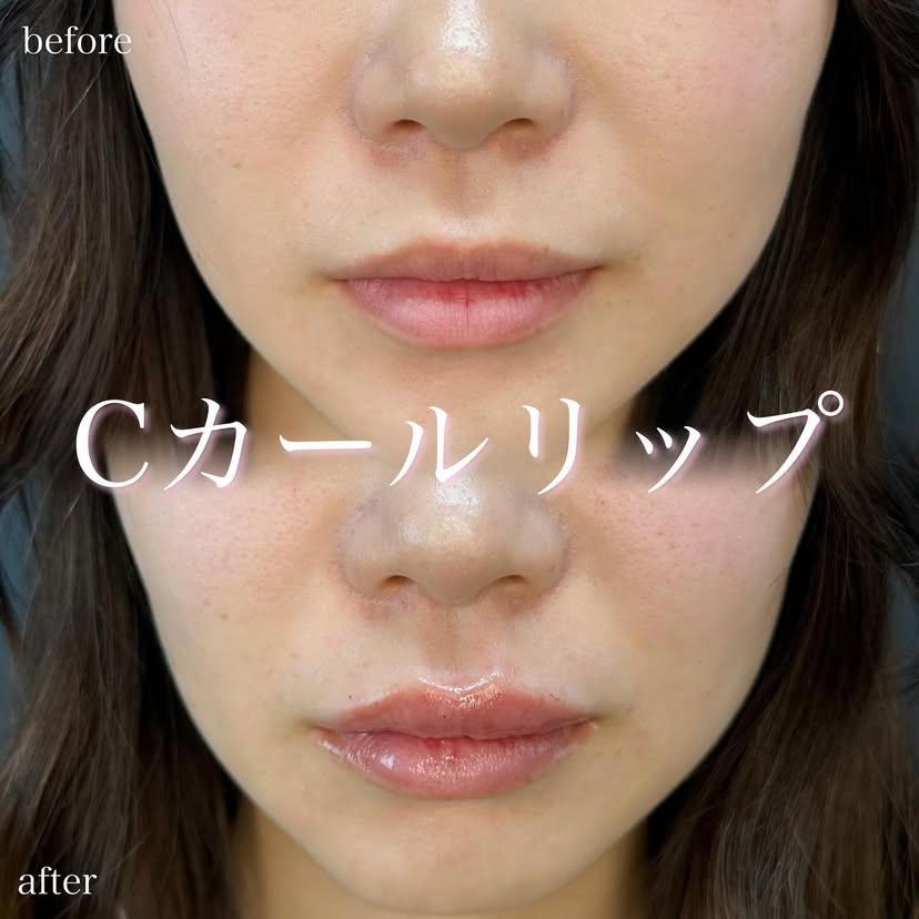 Cカールリップの症例写真