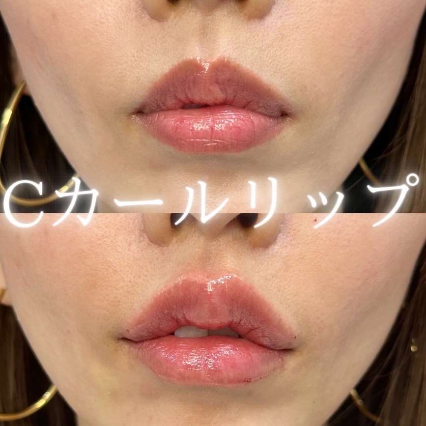 Cカールリップの症例写真