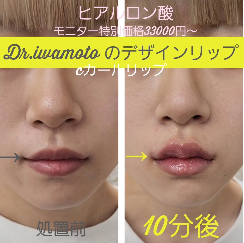 Cカールリップの症例写真