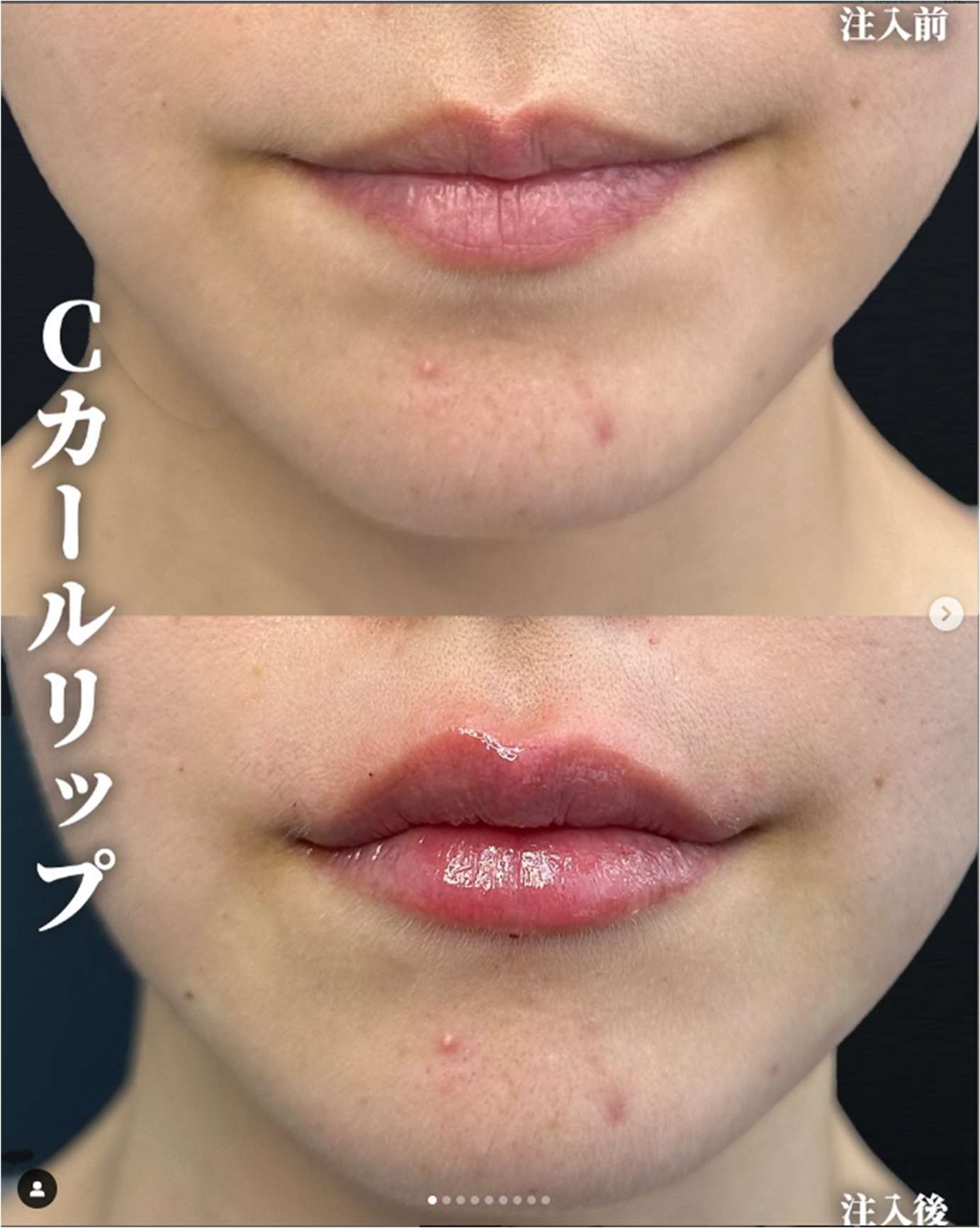 Cカールリップの症例写真