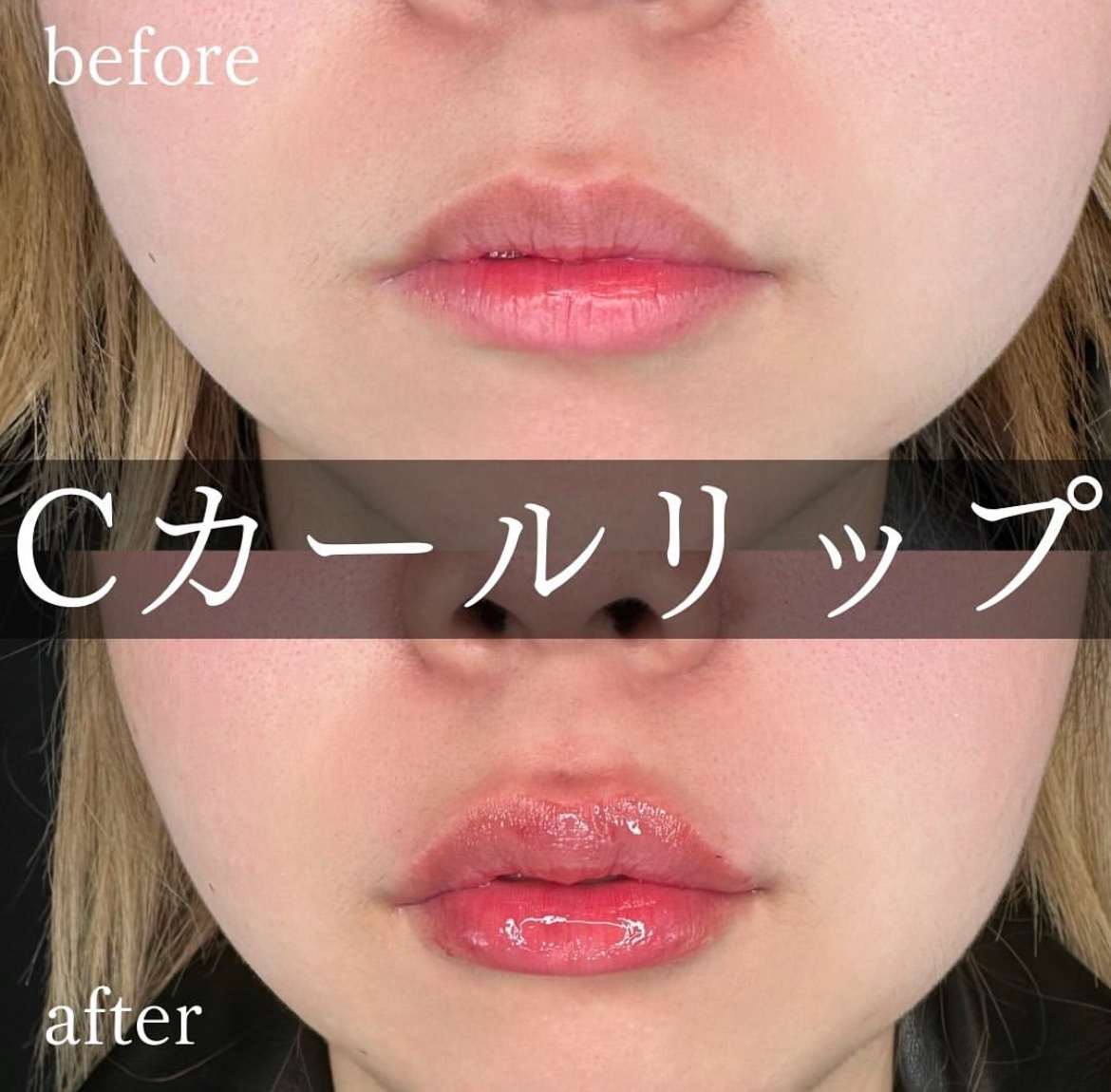 Cカールリップの症例写真