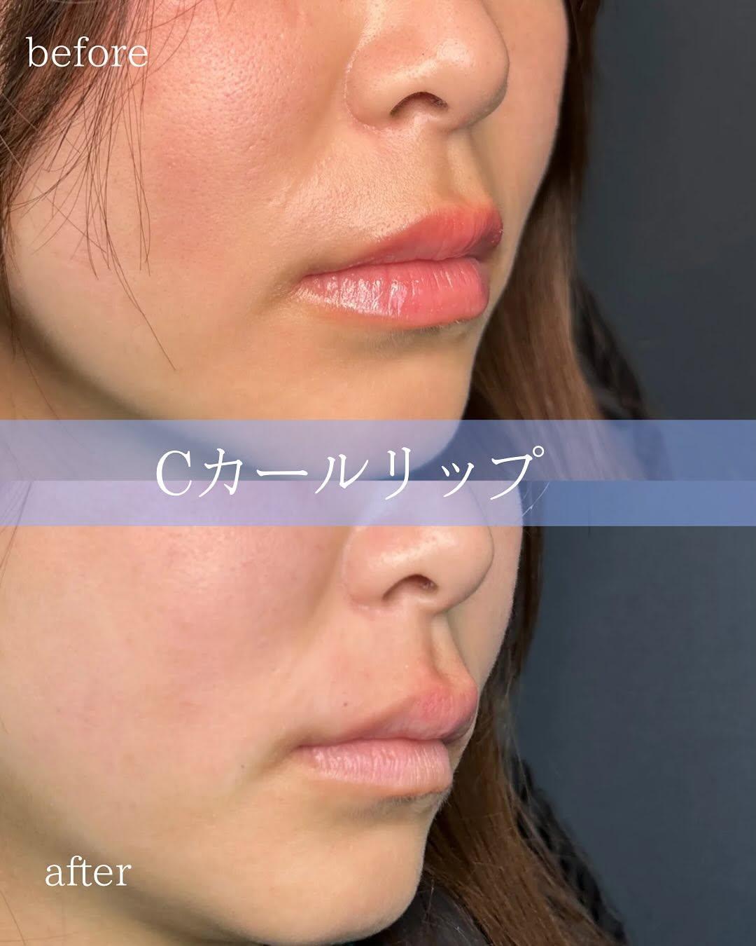 Cカールリップの症例写真
