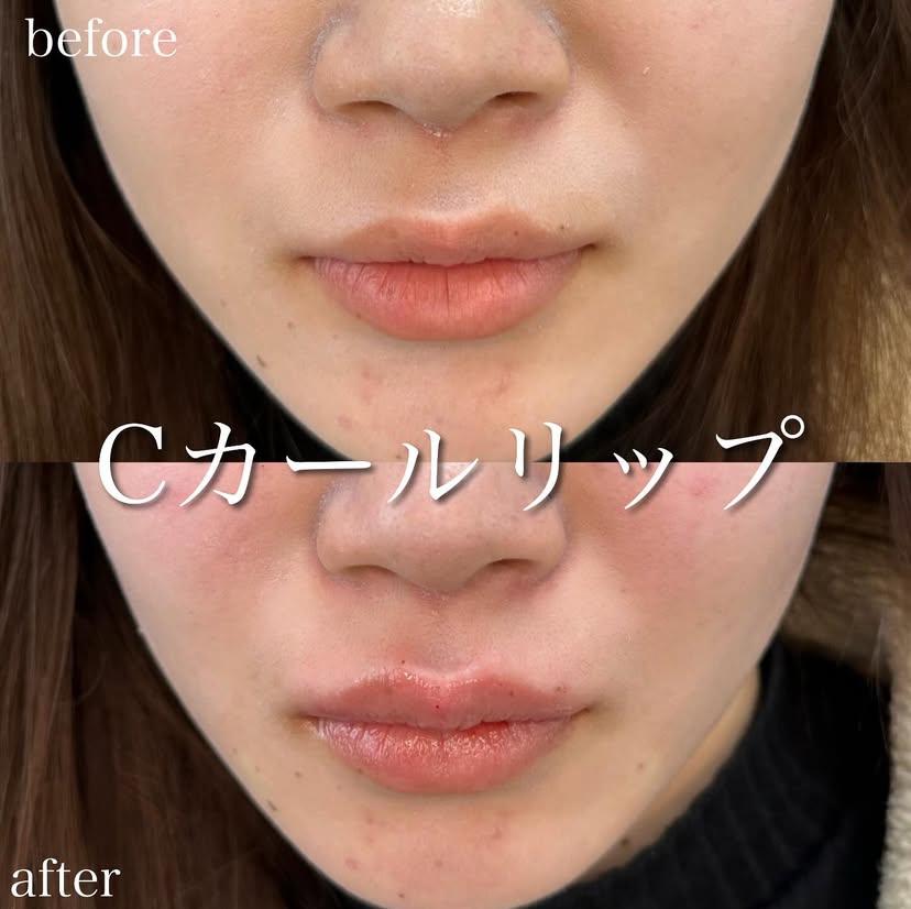 Cカールリップの症例写真