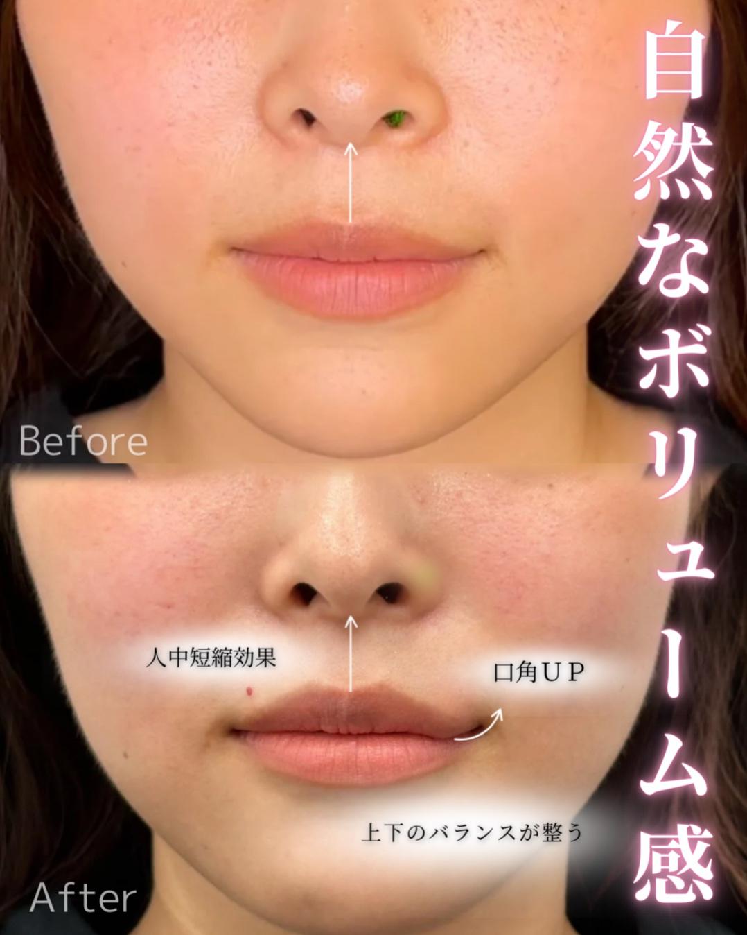 Cカールリップの症例写真