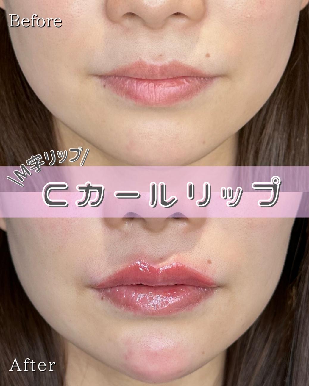 Cカールリップの症例写真