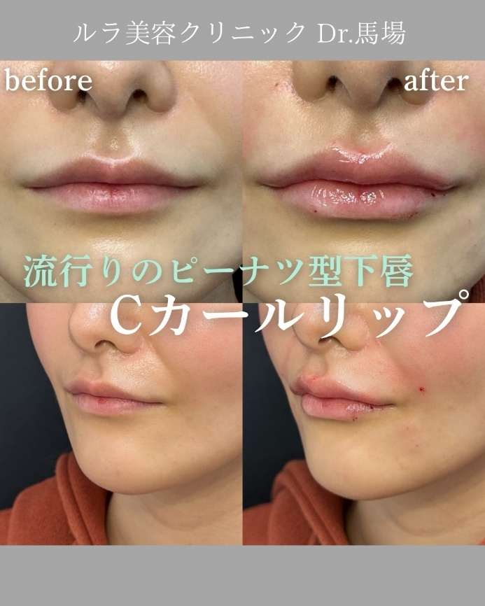 Cカールリップの症例写真