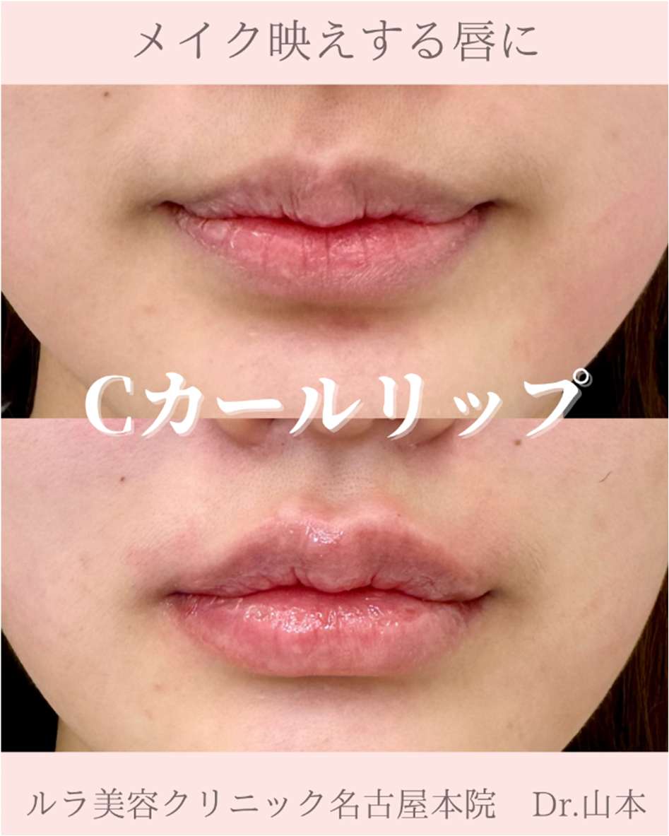 Cカールリップの症例写真
