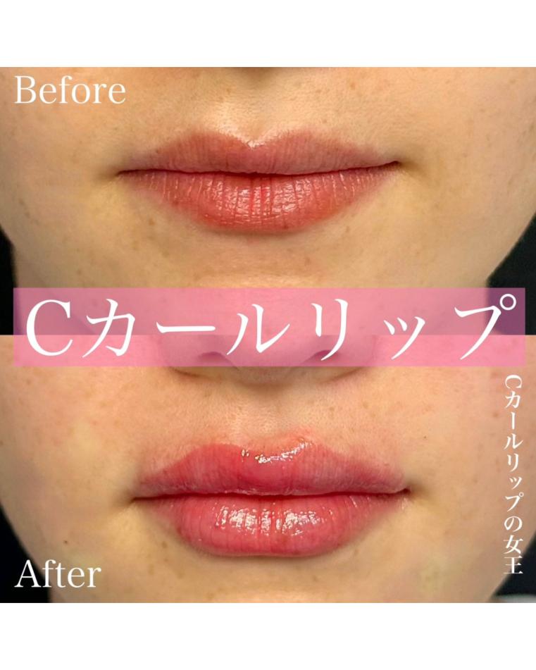 Cカールリップの症例写真