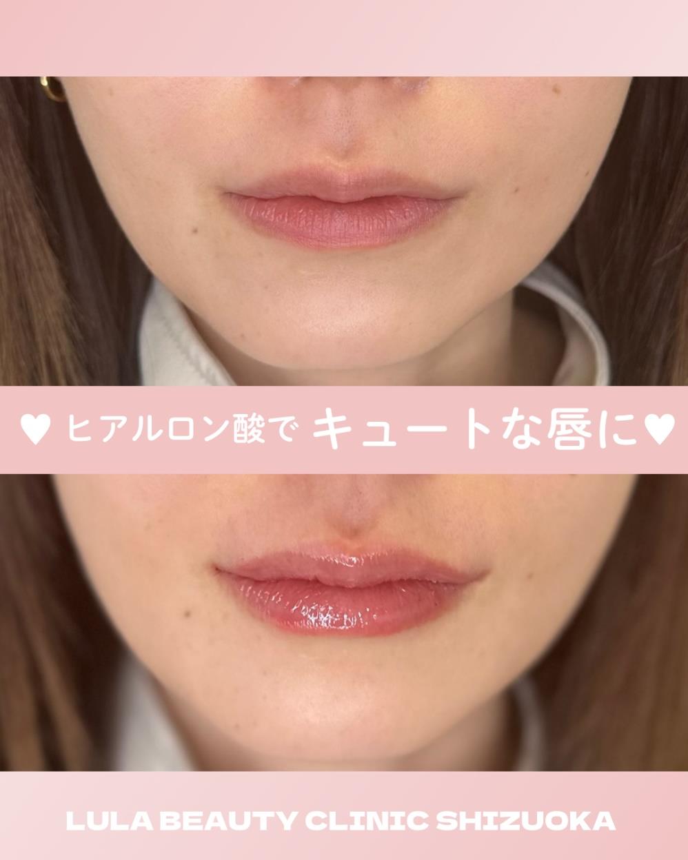 Cカールリップの症例写真