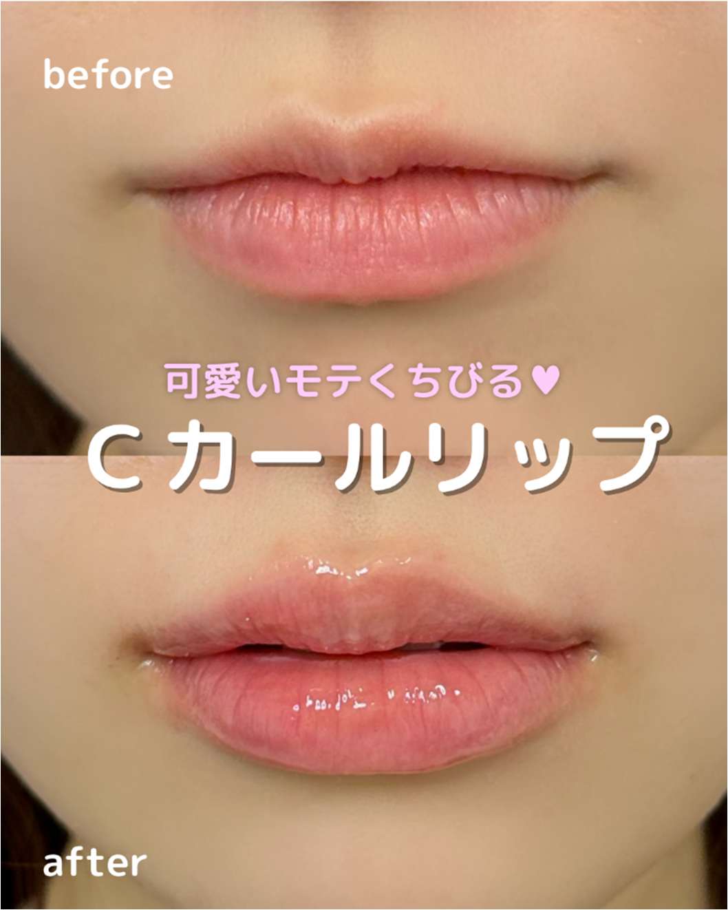 Cカールリップの症例写真