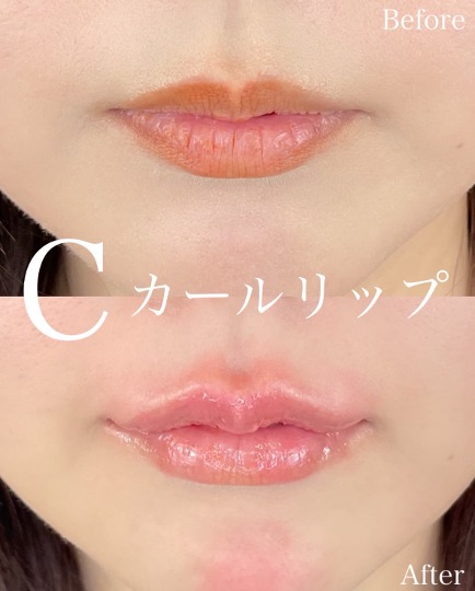 Cカールリップの症例写真