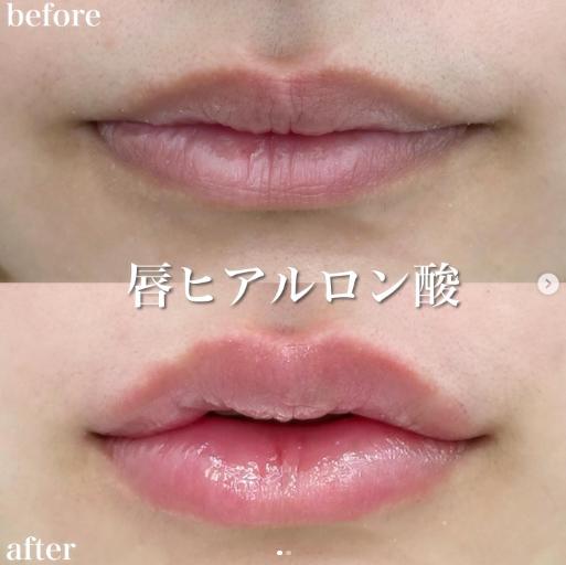 Cカールリップの症例写真