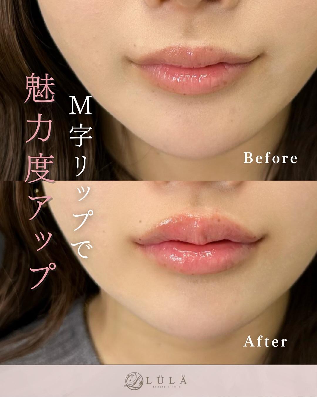 Cカールリップの症例写真
