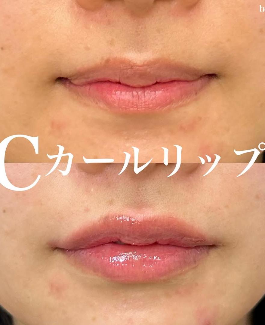 Cカールリップの症例写真