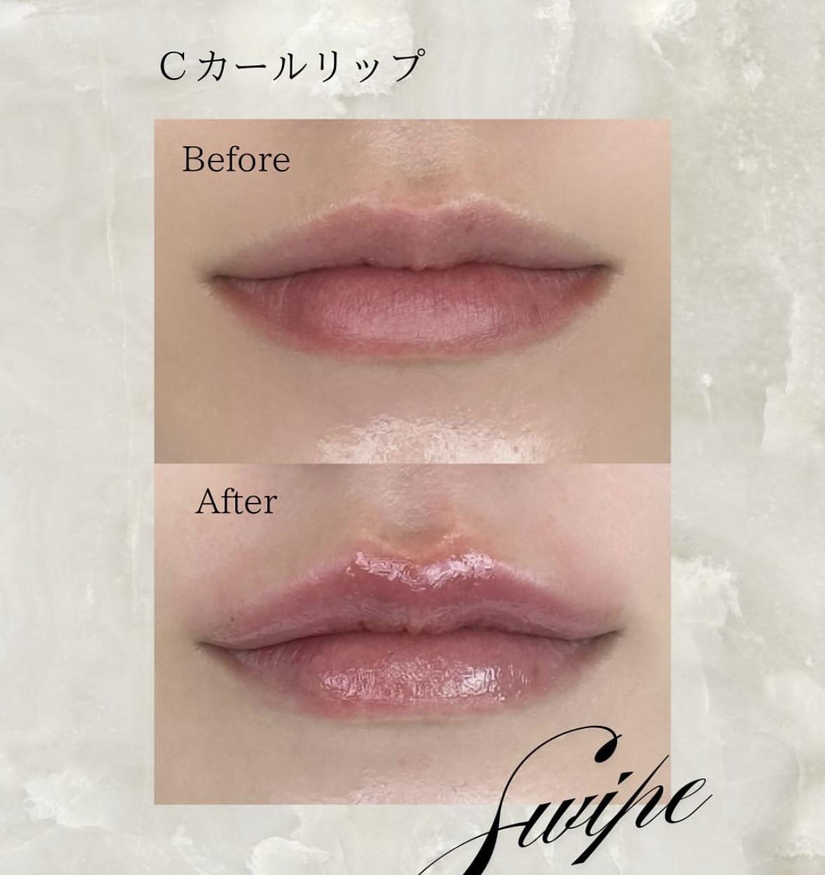 Cカールリップの症例写真