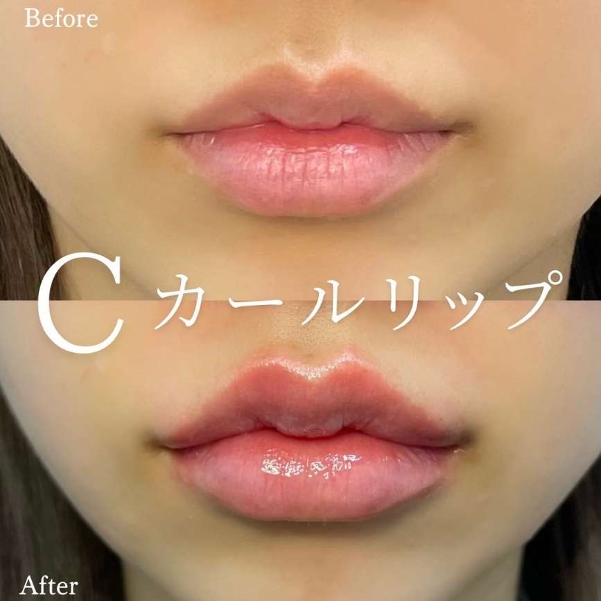 Cカールリップの症例写真