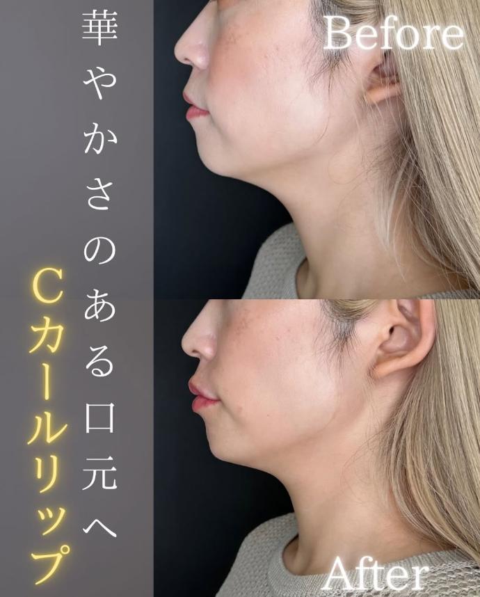 Cカールリップの症例写真