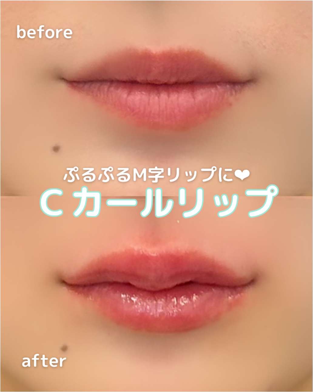 Cカールリップの症例写真