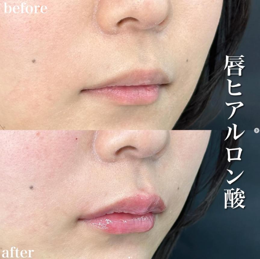 Cカールリップの症例写真
