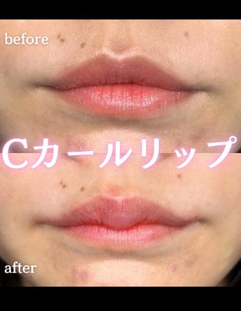 Cカールリップの症例写真