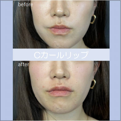 Cカールリップの症例写真