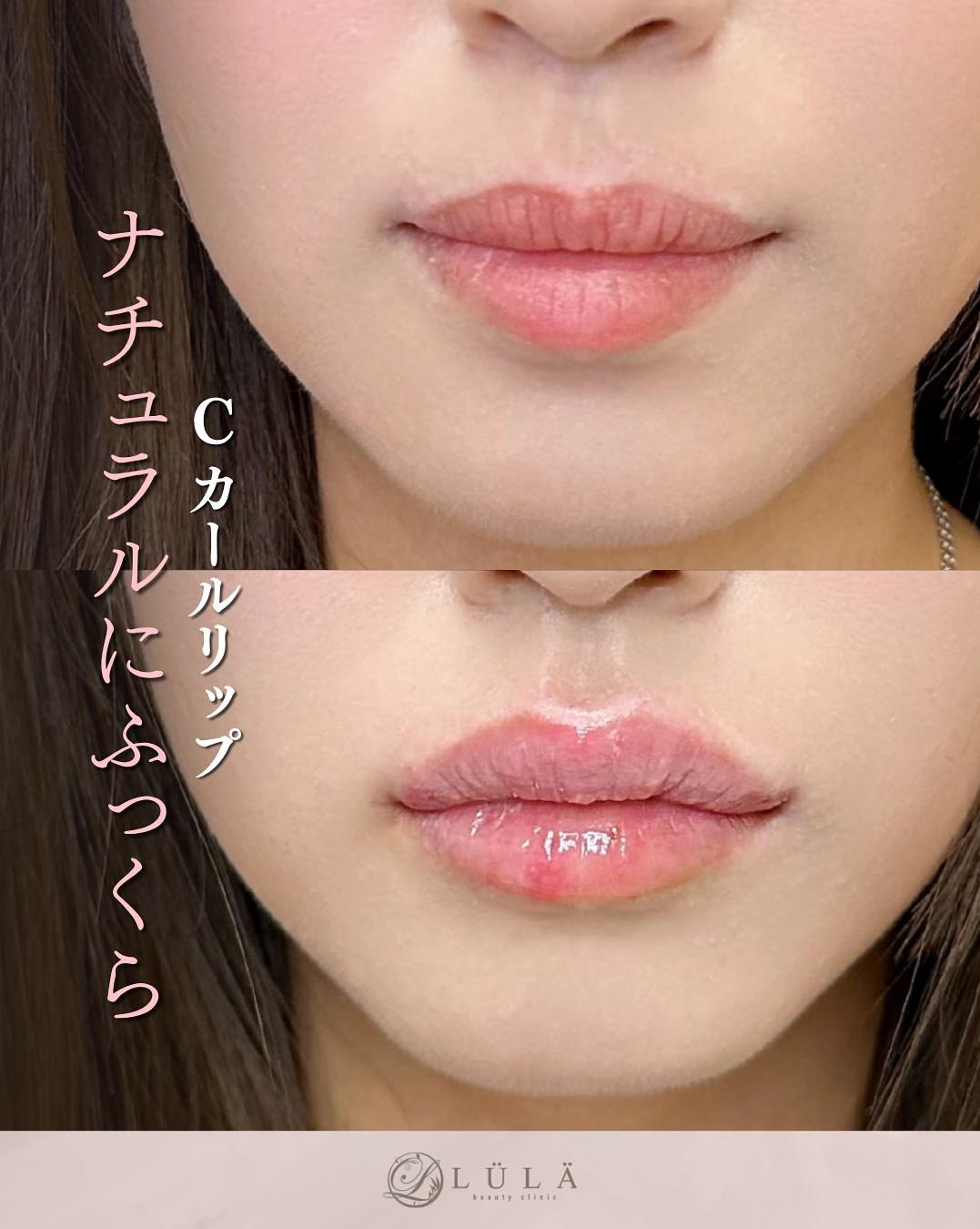 Cカールリップの症例写真