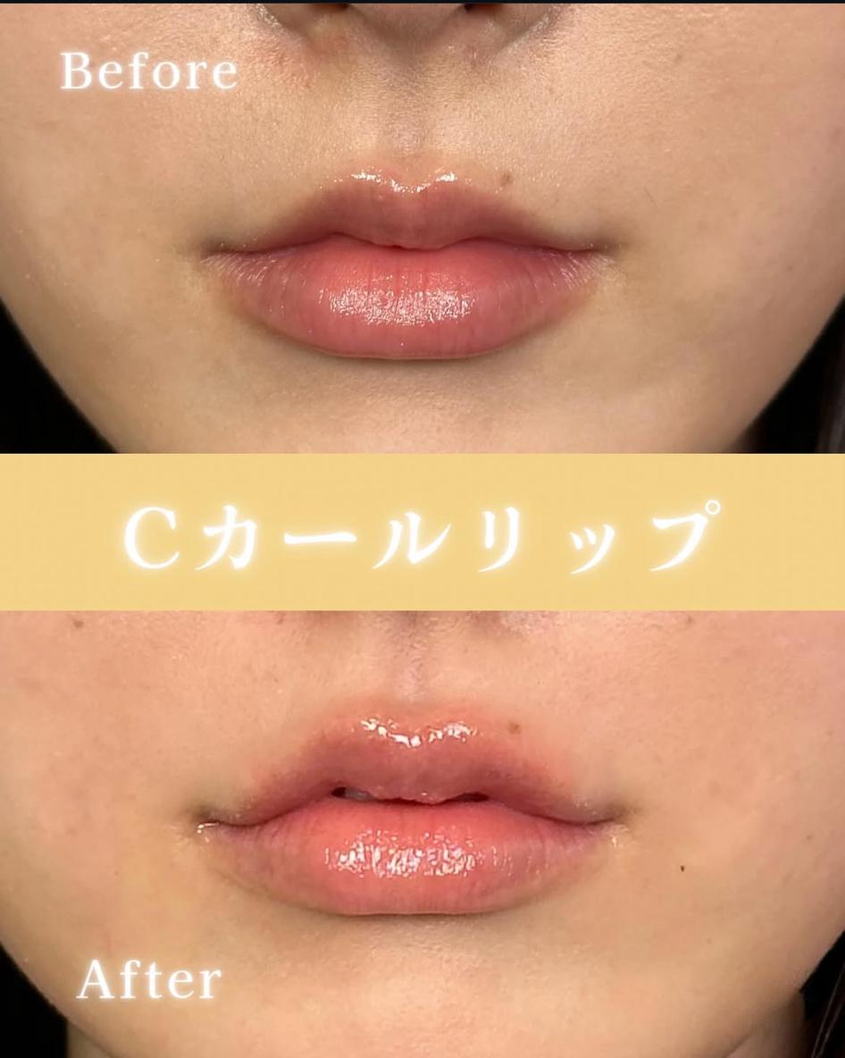Cカールリップの症例写真