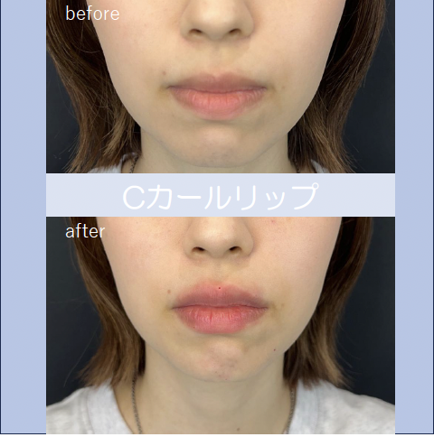 Cカールリップの症例写真