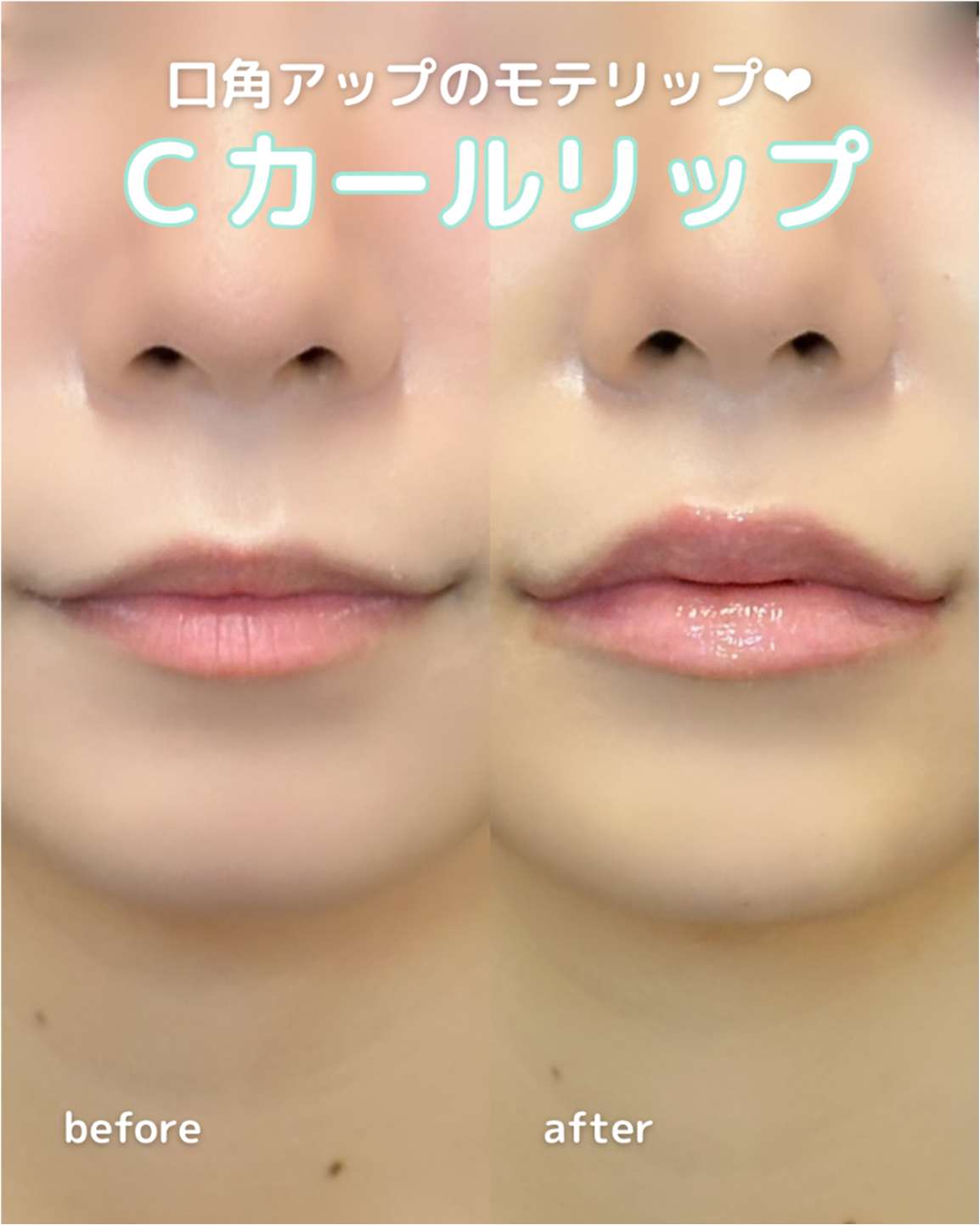 Cカールリップの症例写真