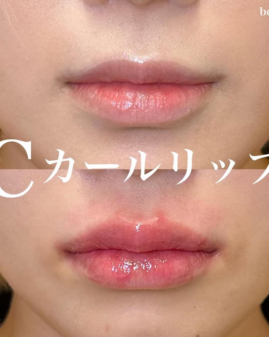 Cカールリップの症例写真