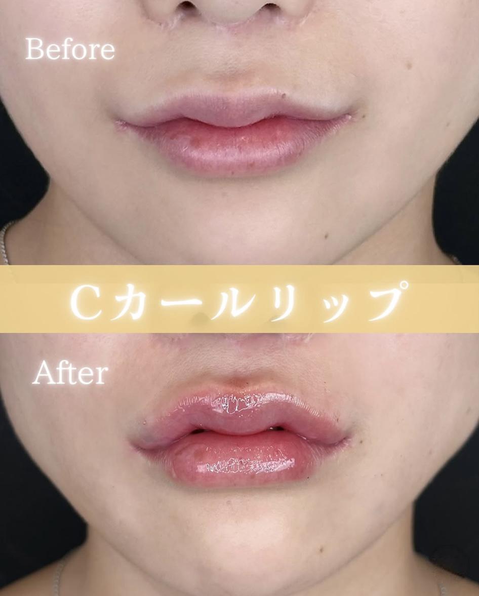 Cカールリップの症例写真