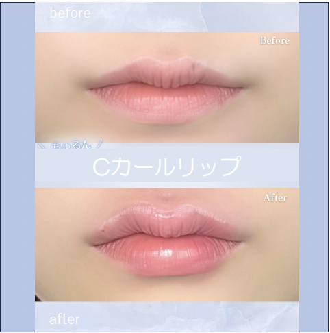 Cカールリップの症例写真