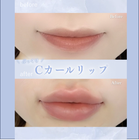 Cカールリップの症例写真