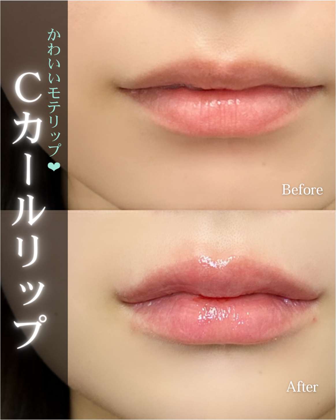 Cカールリップの症例写真