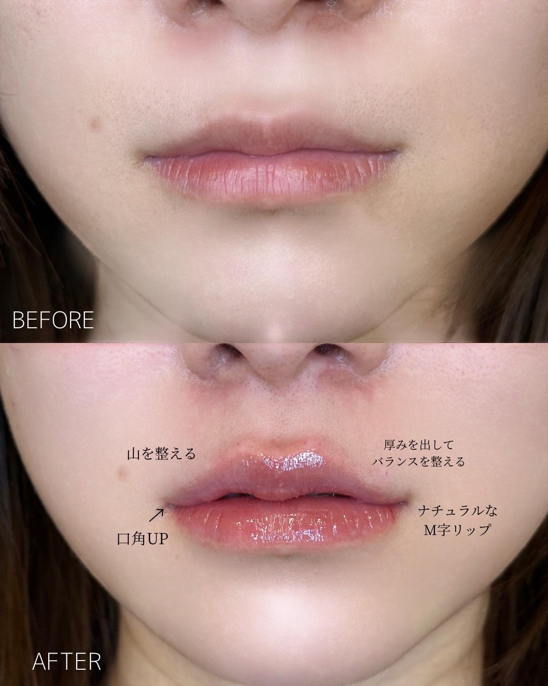 Cカールリップの症例写真
