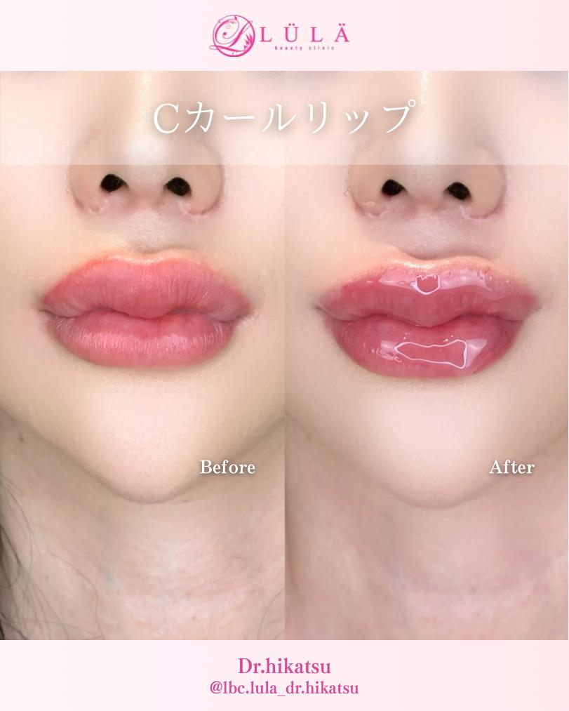 Cカールリップの症例写真