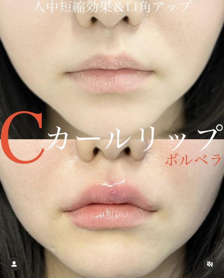 Cカールリップの症例写真