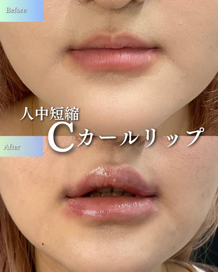 Cカールリップの症例写真