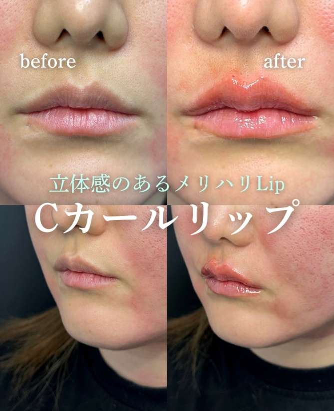 Cカールリップの症例写真