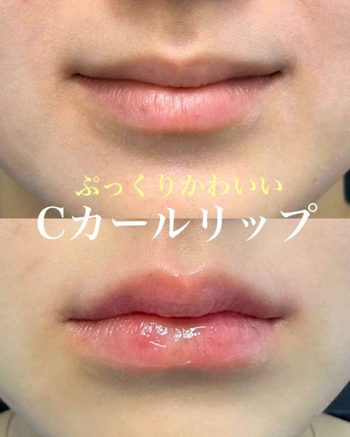 Cカールリップの症例写真