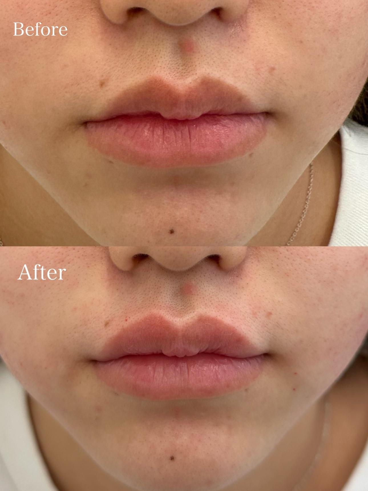 Cカールリップの症例写真