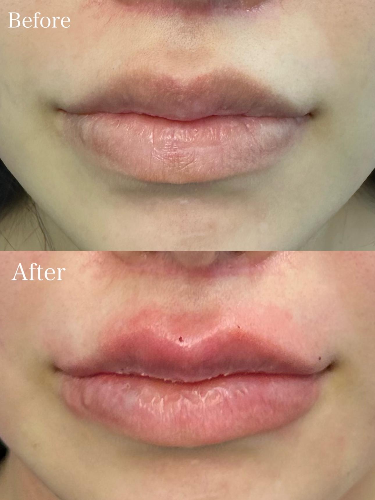 Cカールリップの症例写真