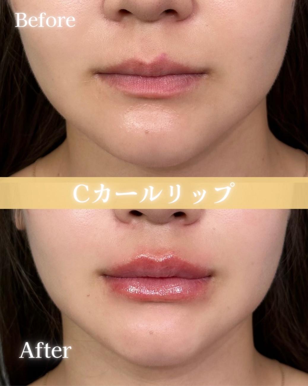 Cカールリップの症例写真