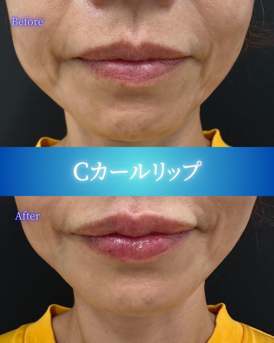 Cカールリップの症例写真