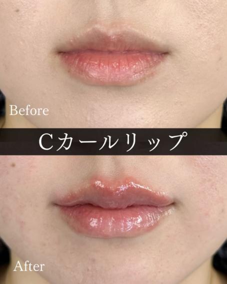 Cカールリップの症例写真