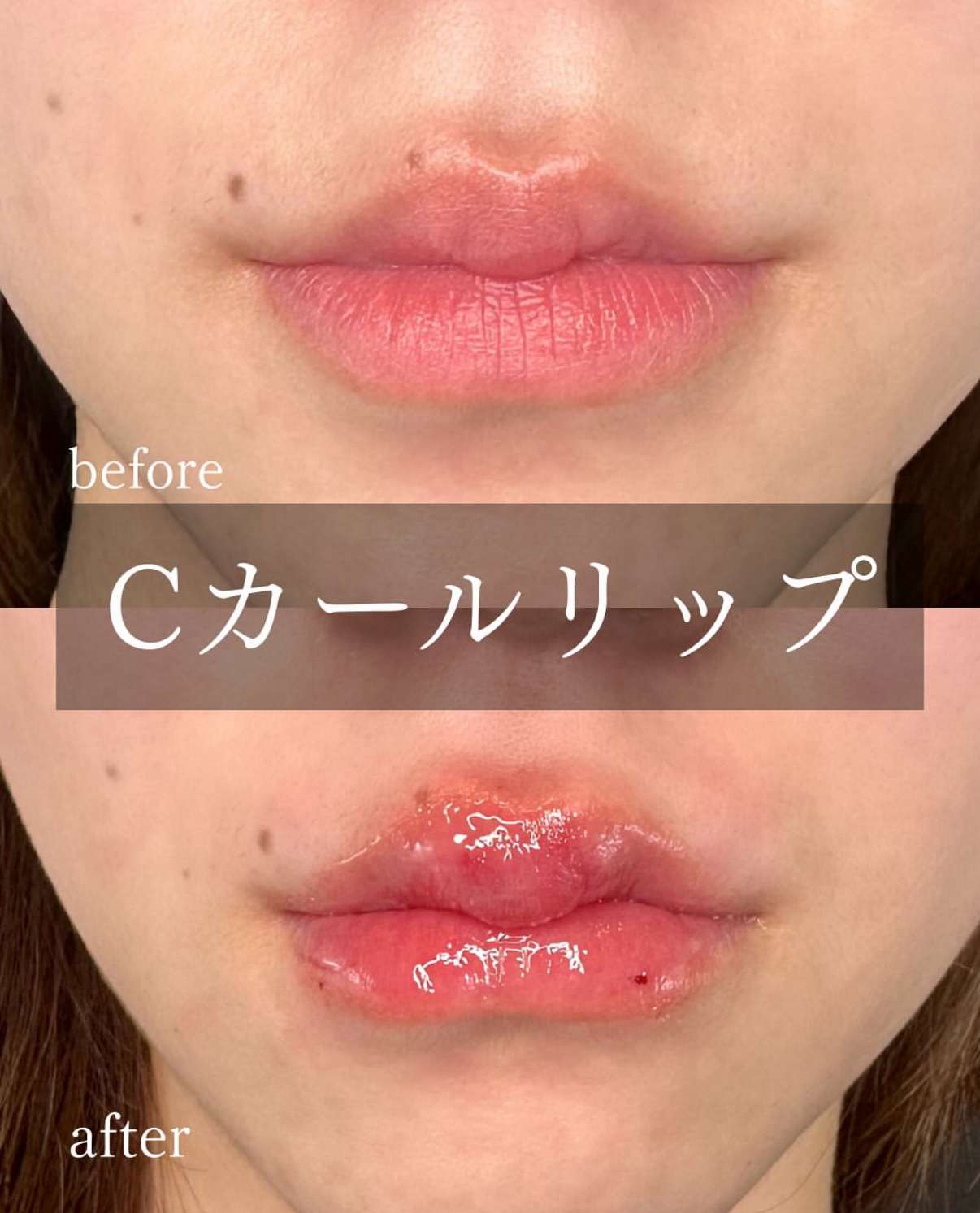 Cカールリップの症例写真